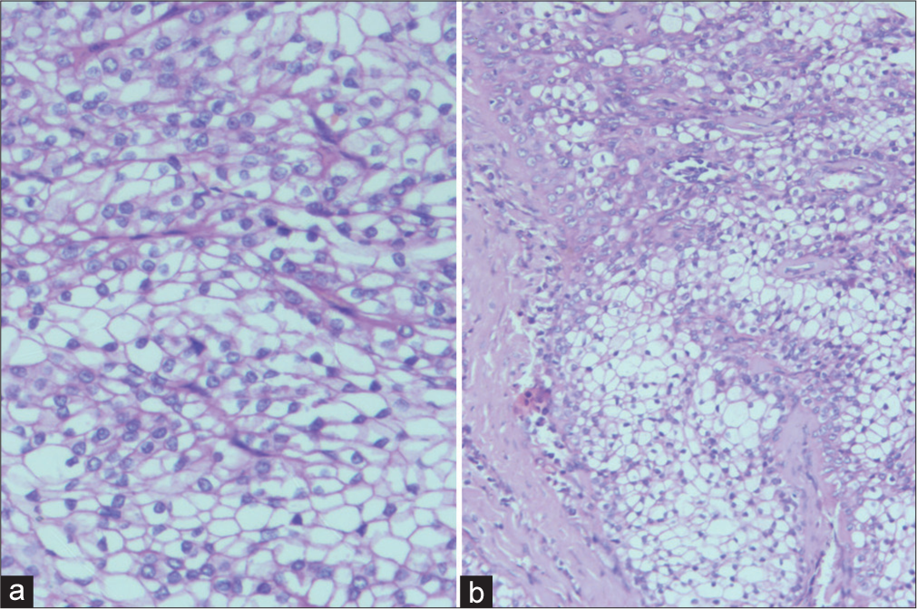 (a) Section highlights the higher magnification of the tumor cells exhibiting no evidence of nuclear atypia or mitotic activity (hematoxylin and eosin stain, ×400). (b) Section highlights the lobular architecture of tumor cells with delicate vasculature and circumscription (hematoxylin and eosin stain, ×200).