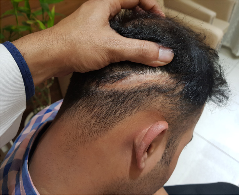 Linear scar visible in the donor area with follicular unit transplantation (FUT).