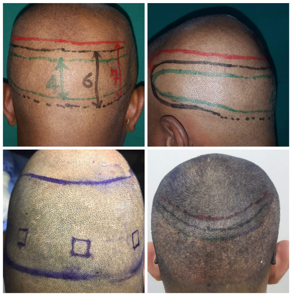 Posterior and lateral view of scalp showing limited, standard and extended safe donor area of the scalp.
