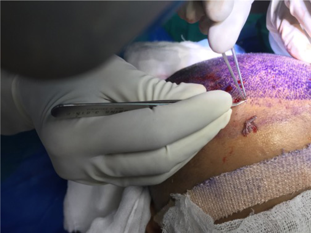Implantation of follicular units using fine angled forceps.