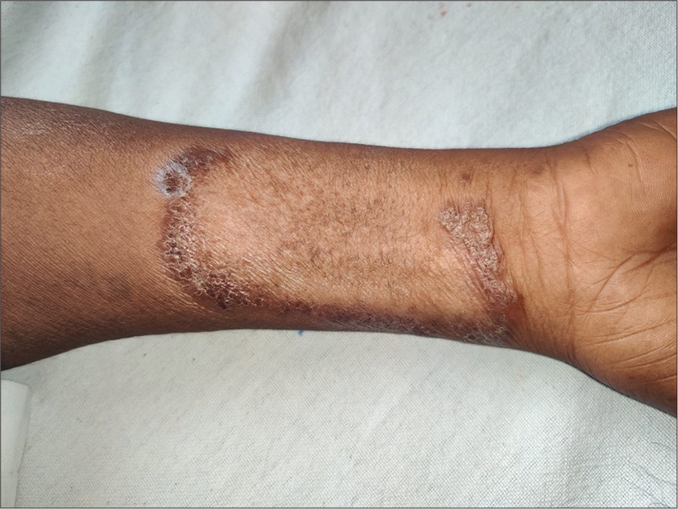 A red-brown arcuate plaque showing peripheral infiltrated advancing margin with central scarring and hypopigmentation over the right forearm.