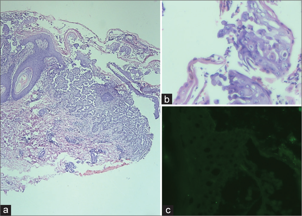 (a) Section shows acanthotic epidermis with suprabasal and intraepidermal acantholysis. Hair follicles and adnexal structures are spared (hematoxylin and eosin stain, ×40). (b) Section shows acantholytic cells with focal dyskeratosis. Parakeratosis and neutrophilic infiltrates in the keratin layer are evident (hematoxylin and eosin stain, ×400). (c) Section shows absence of IgG staining in the epidermis (direct immunofluorescence with immunoglobulin G, DAKO monoclonal antibody, USA, ×400).