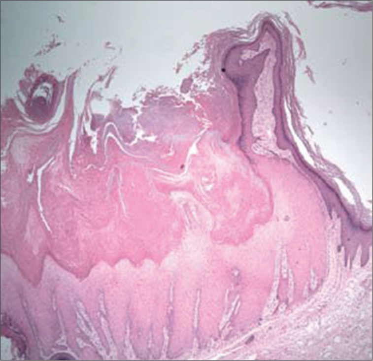 Cutaneous horn shown in Figure 2; a keratoacanthoma with typical hyperkeratosis with associated parakeratosis, overlying a keratoacanthoma (hematoxylin-eosin ×100). (Fernandes et al., Acta Dermatoven APA Vol 18, 2009; reprinted with permission).