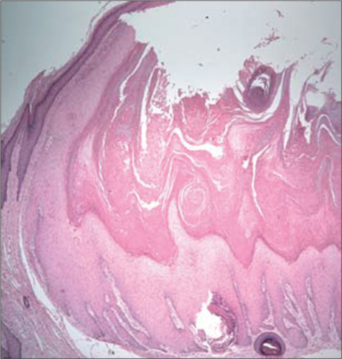 Edge of the keratoacanthoma, at the base of the cutaneous horn, with proliferating squamous epithelial cells (hematoxylineosin ×100). (Fernandes et al., Acta Dermatoven APA Vol 18, 2009; reprinted with permission).