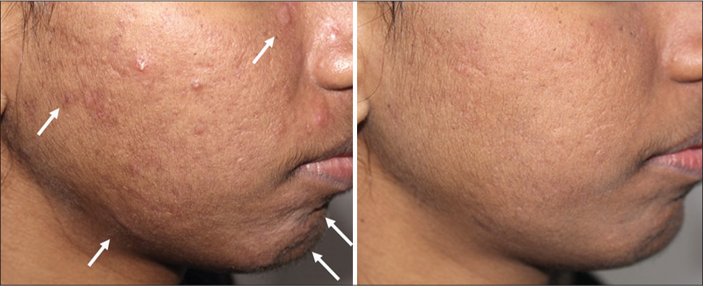 Before and after image showing improvement in scarring, treated by fractional Co2 laser plus 4% retinol peel and laser-assisted triamcinolone acetonide application for areas of hypertrophic and pre-keloidal scarring (arrows), 3 sessions done 2 months apart, in a patient on low-dose isotretinoin for acne management.