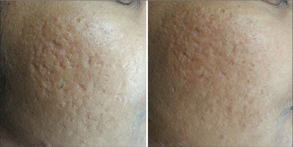 Before and after image showing improvement in acne scars, 4 weeks after a single session of radiofrequency needling.