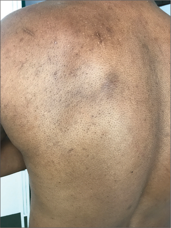 Trichostasis spinulosa affecting back and presenting as minimally keratotic follicular paupules with multiple hair bristles.