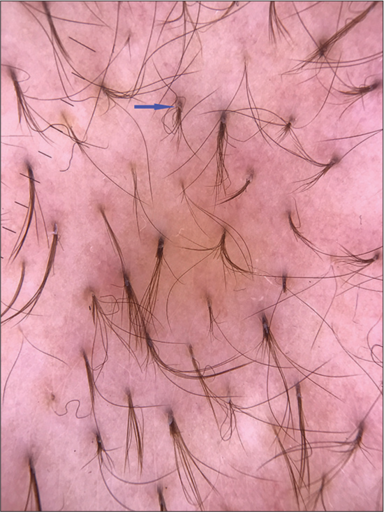 Dermoscopic examination (Dermlite DL4N, polarised mode, x10). Hair retention seen as tufts of tiny dark hair emerging from follicular ostia.