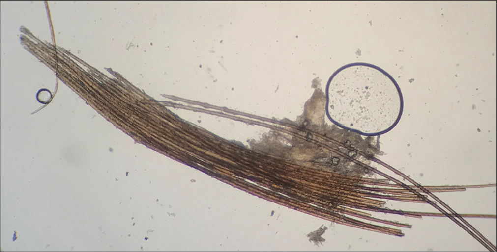 Hair mount of the plucked hairs showing multiple vellus hairs bundled together by a keratinous sheath with characteristic paintbrush appearance.
