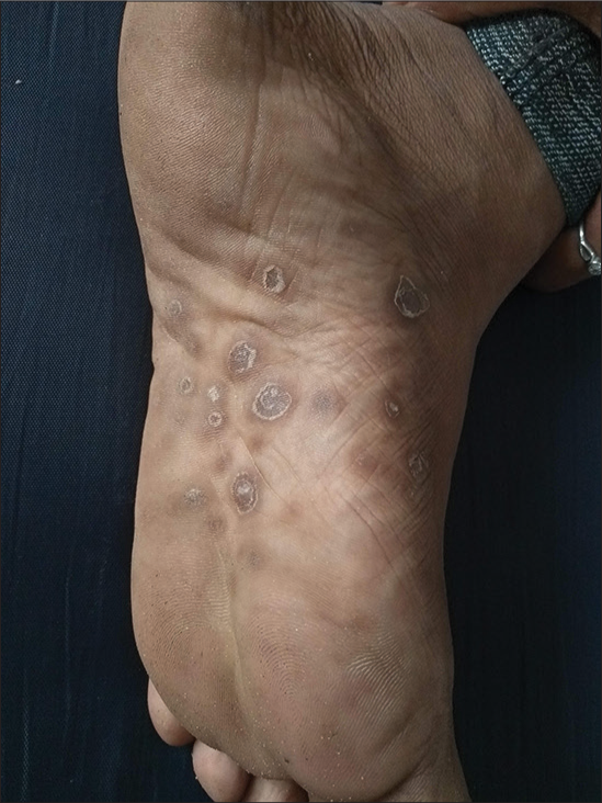Papulosquamous lesions on the sole.