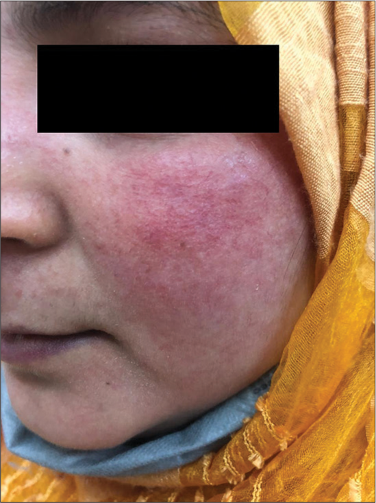 Rosacea like features due to prolonged topical steroid abuse.