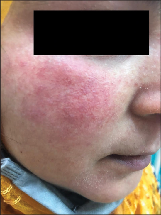 Increases erythema and dryness after using routine household products in the same patient.