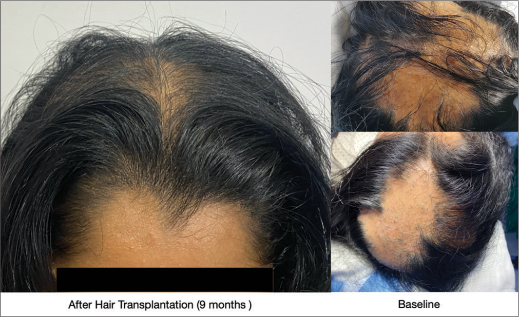 Results of hair transplant in an end-stage scarring alopecia. 1950 grafts planted at a density of 25 units/cm2.