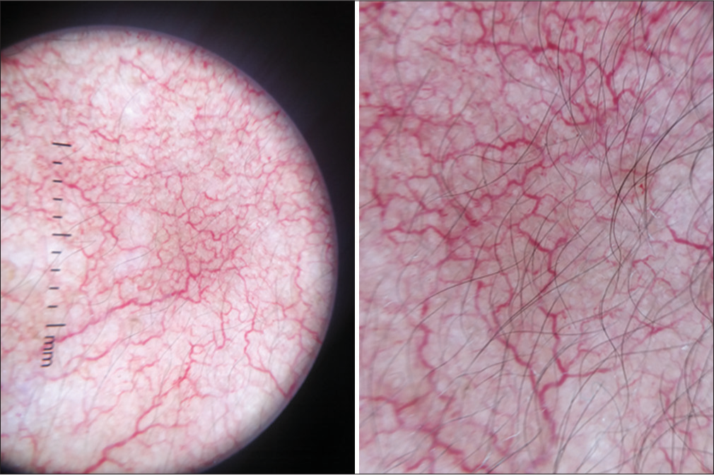 Dermoscopy showing atrophic skin with marked telangiectasia and increased hairiness.