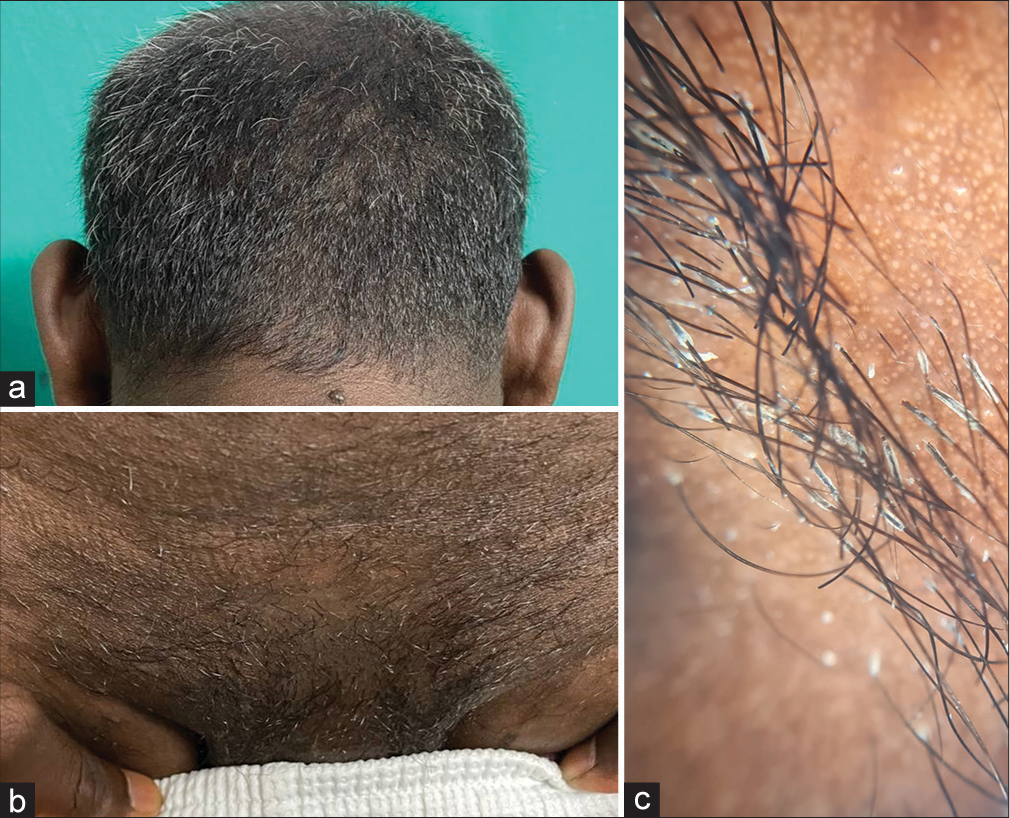 (a) Thin, tubular, whitish concretions ensheathing the hair shaft over the occipital scalp. (b) Thin, tubular, whitish concretions ensheathing the hair shaft over the groin. (c) Dermoscopy showing multiple cylindrical, keratohyaline masses covering the hair shafts circumferentially.