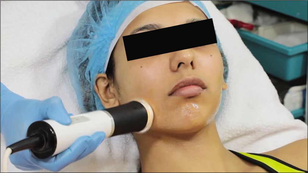 Exfoliation probe for oxygen facial.