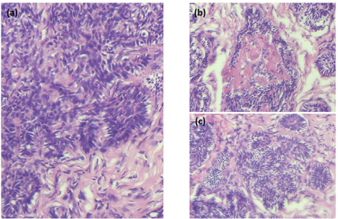 (a) Prominent palisading of the basaloid tumour cells with adjacent cellular stroma (Haematoxylin and Eosin stain, × 400). (b) Basaloid tumor cells arranged in cribriform pattern with thickened basement membrane (Haematoxylin and Eosin stain, × 400). (c) Basaloid tumor cells with no evidence of nuclear atypia, pleomorphism, or mitotic activity (Haematoxylin and Eosin stain, × 400).