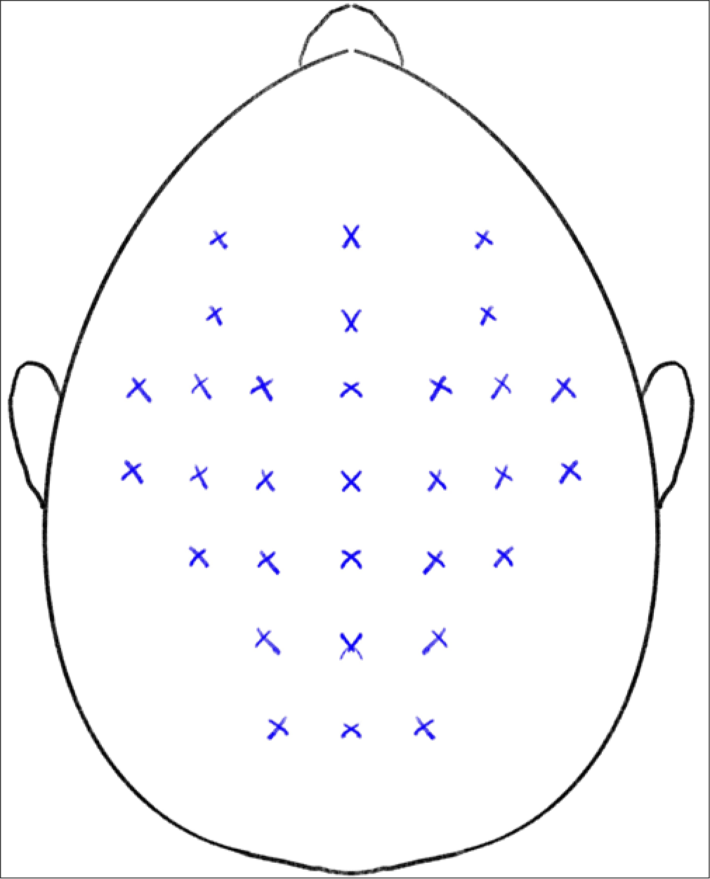 Technique of BT injection for androgenetic alopecia.