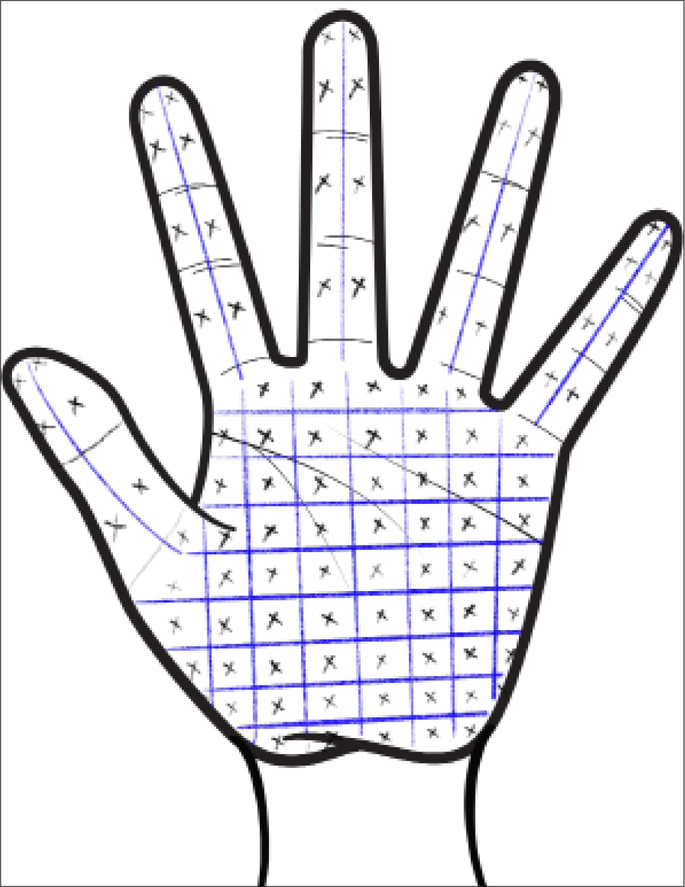 Technique of BT injection for palmar hyperhidrosis.