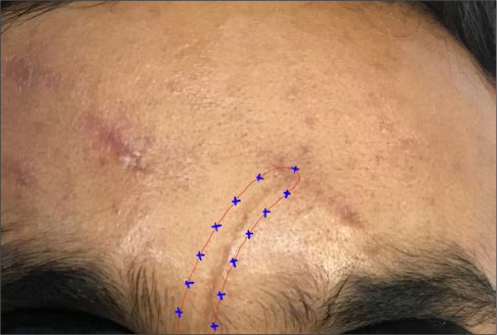 Technique of BT injection for scar revision.