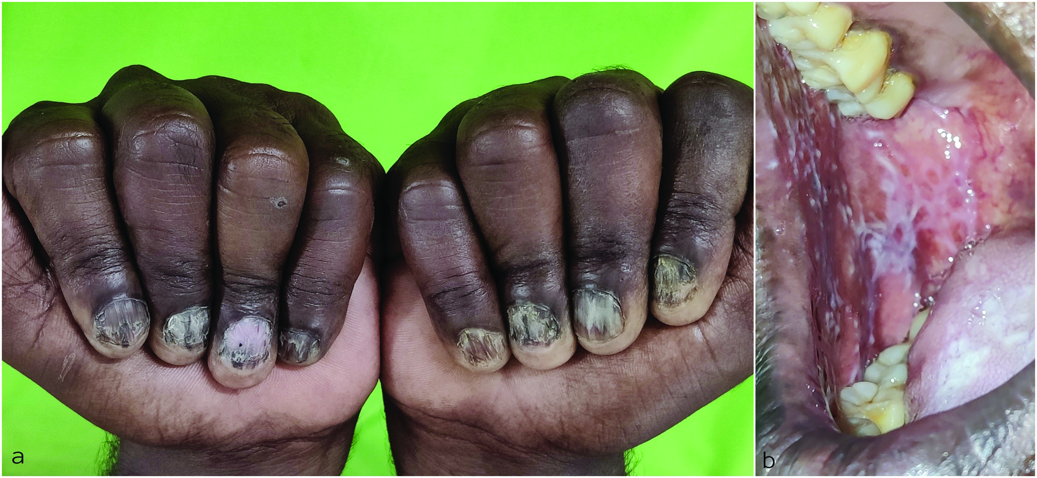 (a) Brittle, thin nails with increased longitudinal ridging resulting in a rough, opaque appearance (b) Reticulate, white lesions over the buccal mucosa.