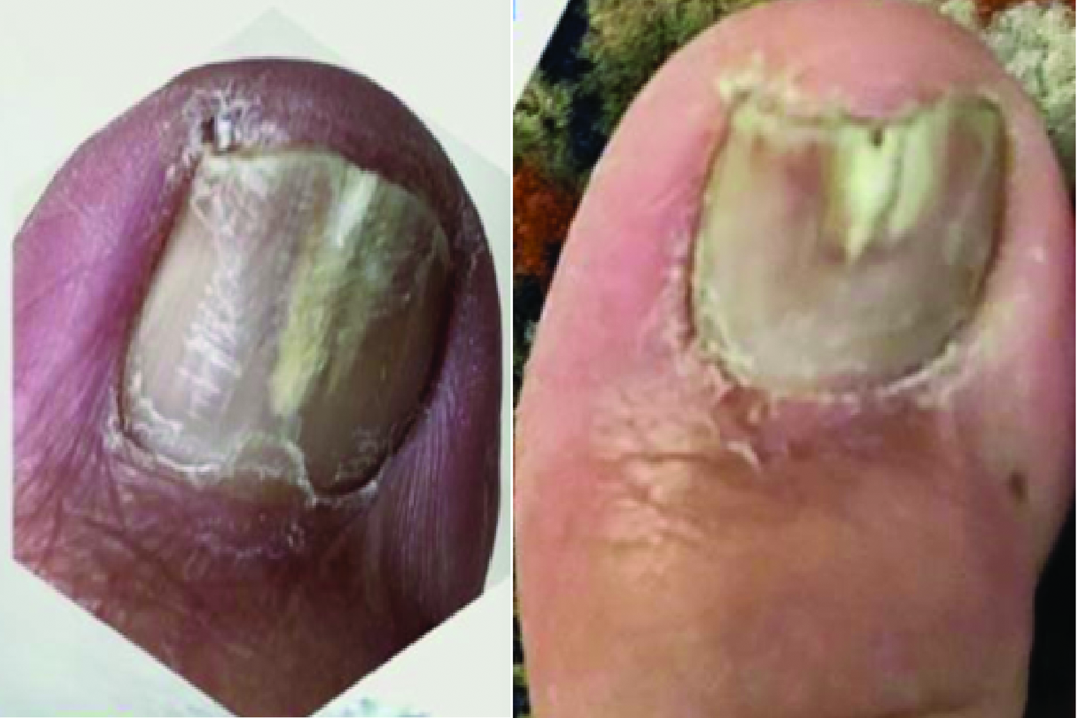 A 60 year old male presented with a clinical diagnosis of onychomycosis of right great toe, which showed no improvement after six months of oral antifungals. He was given 3 monthly sessions of Q switched Nd:YAG laser with 2 to 3 passes at wavelength 1064 nm in nanosecond mode with spot size 6mm and energy 4 J/cm2, followed by 5 passes with spot size 8 mm and energy 2.2 J/cm2. Fractional CO2 laser was then done with 100 micro beams at 30 mJ energy. Follow-up after 3 months from last sessions showed clinical improvement as reduction in the area of involvement.