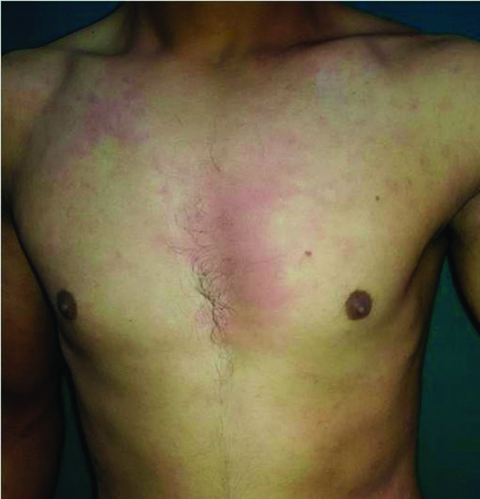 Allergic contact dermatitis of the chest from a perfume spray.