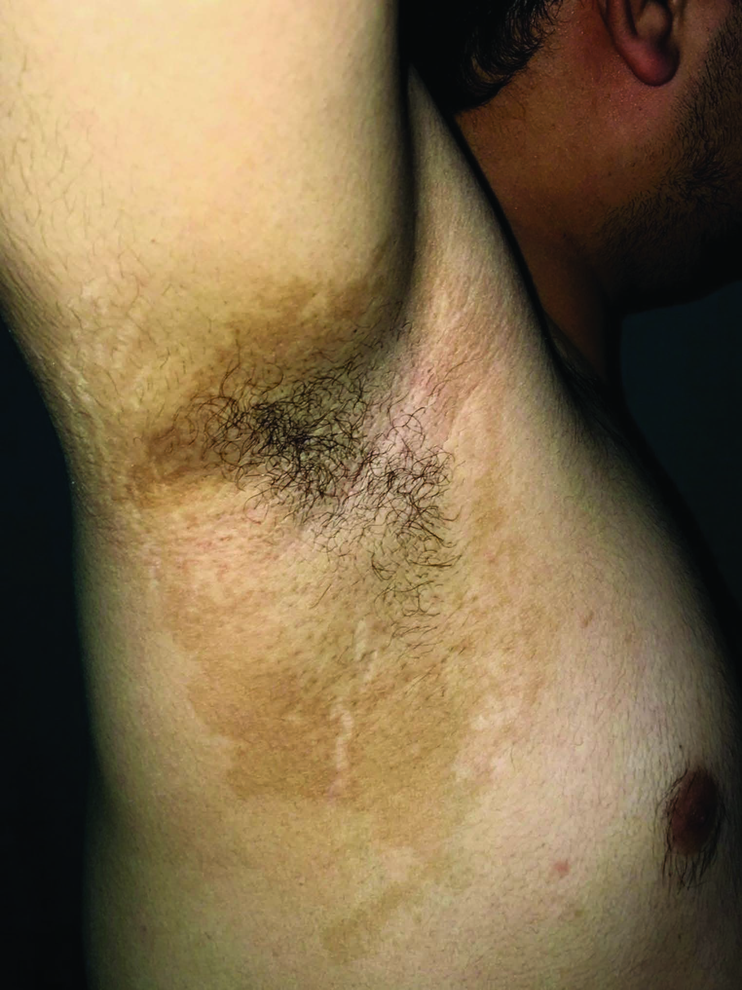 Pigmented contact dermatitis in the axilla caused by cologne spray.