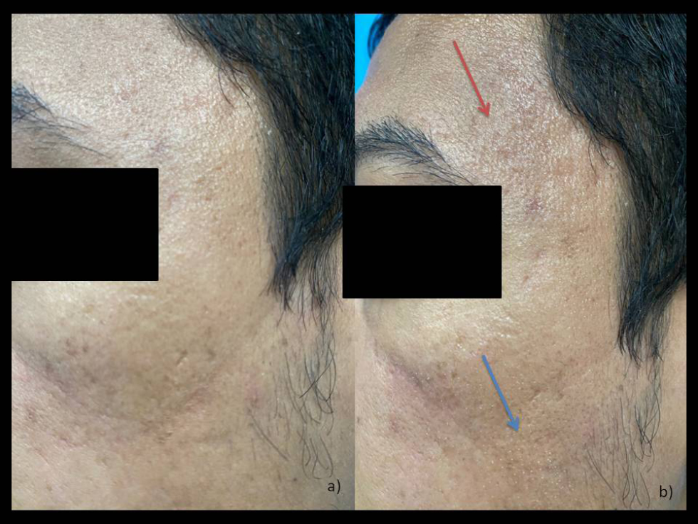 (a) Preprocedure image with acne scars. (b) Immediately postprocedure with red arrow showing erythema and blue arrow showing the ablated area in grid pattern.