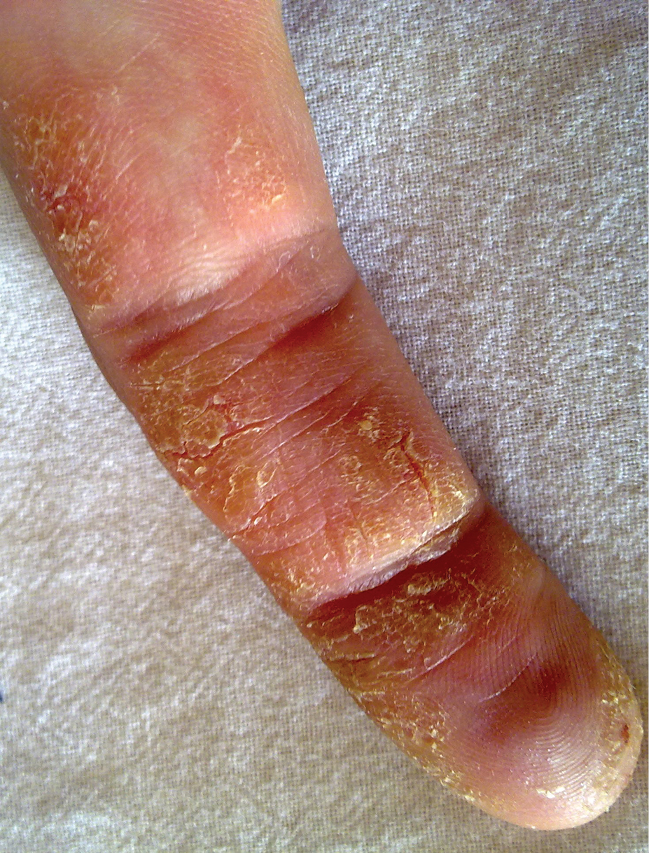 Chronic contact dermatitis.