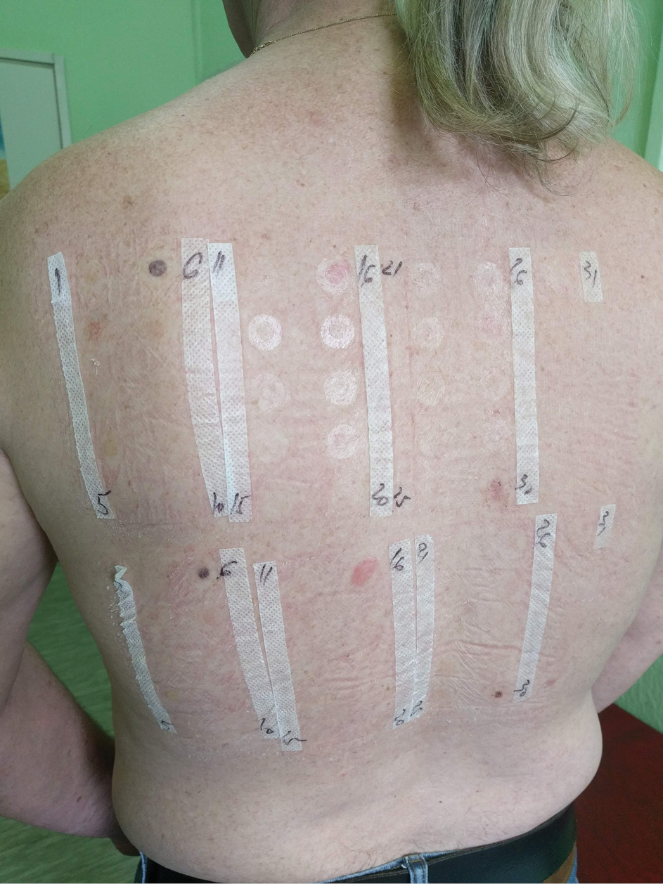 Photopatch testing. The proximal set was exposed to UVA after 48 h while the distal set was covered with photoprotective material. Both sets showed a positive reaction (++) to thimerosal 0.1% at day 4 of testing (2 days after UVA exposition) suggesting only contact sensitivity.