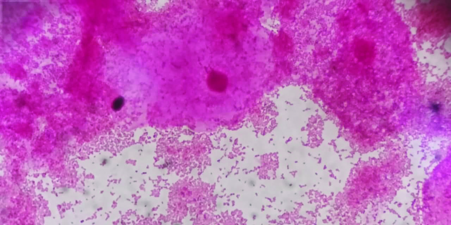 Gram stain of discharge in bacterial vaginosis showing clue cells.