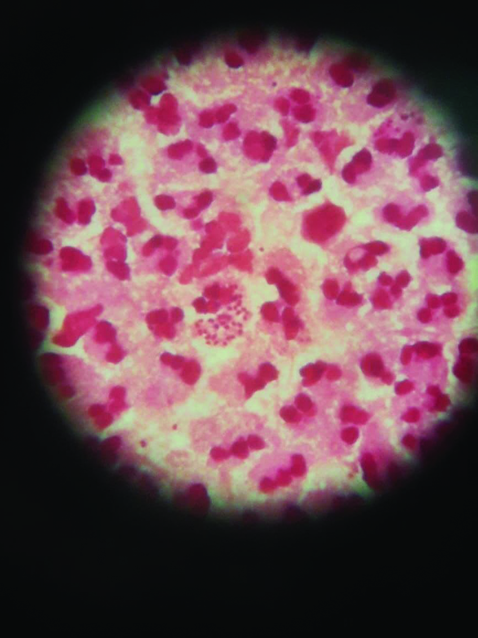 Gram stain of urethral discharge showing gram-negative intracellular diplococci in gonorrhea.