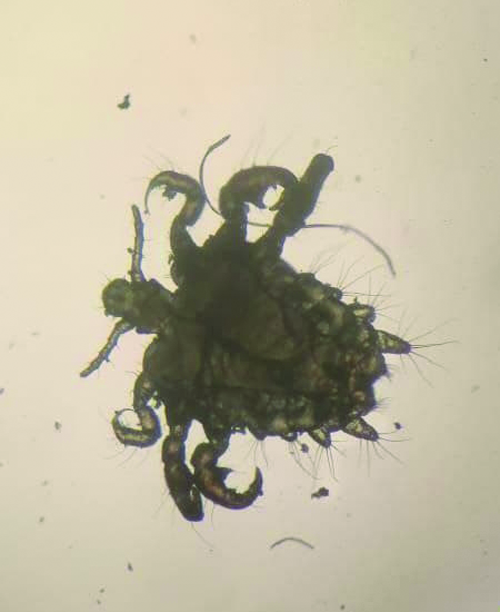 Pthirus Pubis or crab louse observed under 10× magnification.