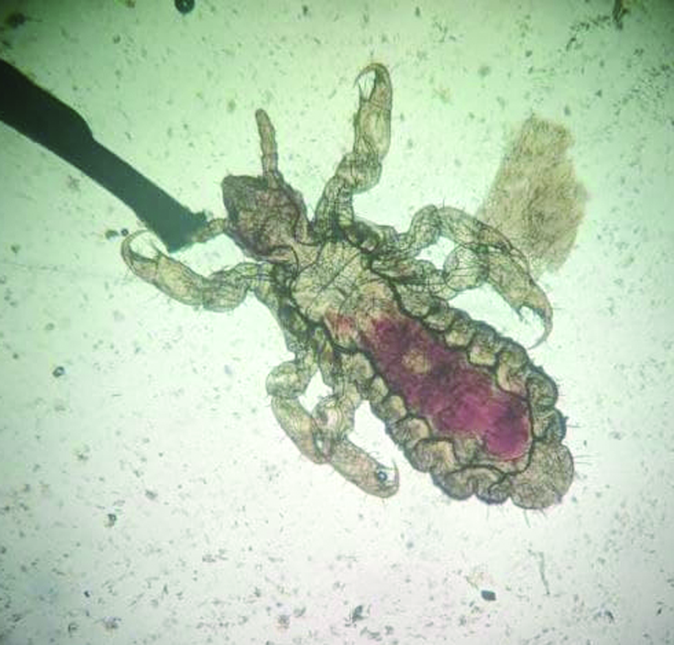 Head louse or pediculosis capitis with blood meal observed under a microscope (10×).