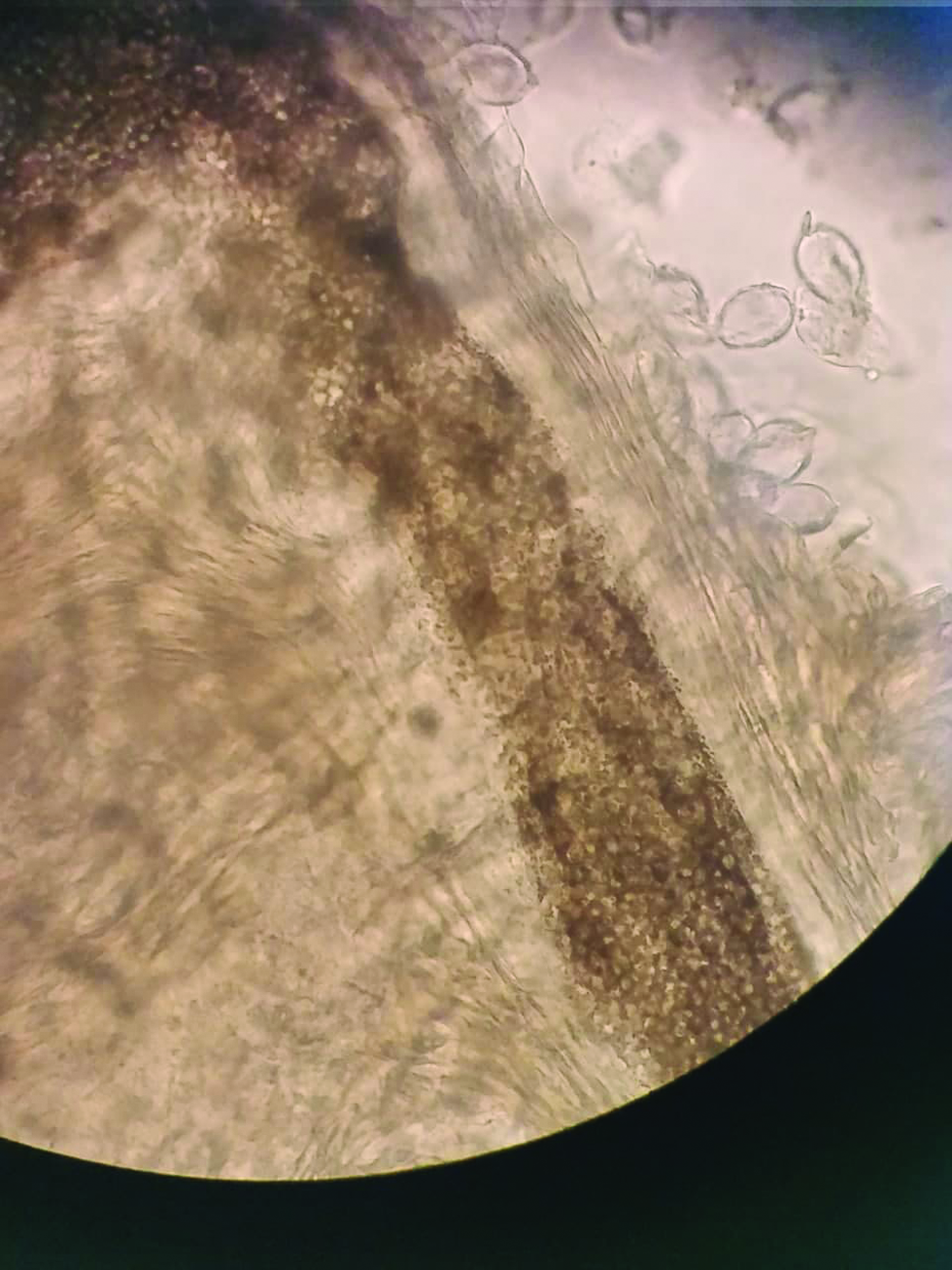 Hair shaft KOH mount showing “sack of marbles” appearance of fungal spores in endothrix infection.