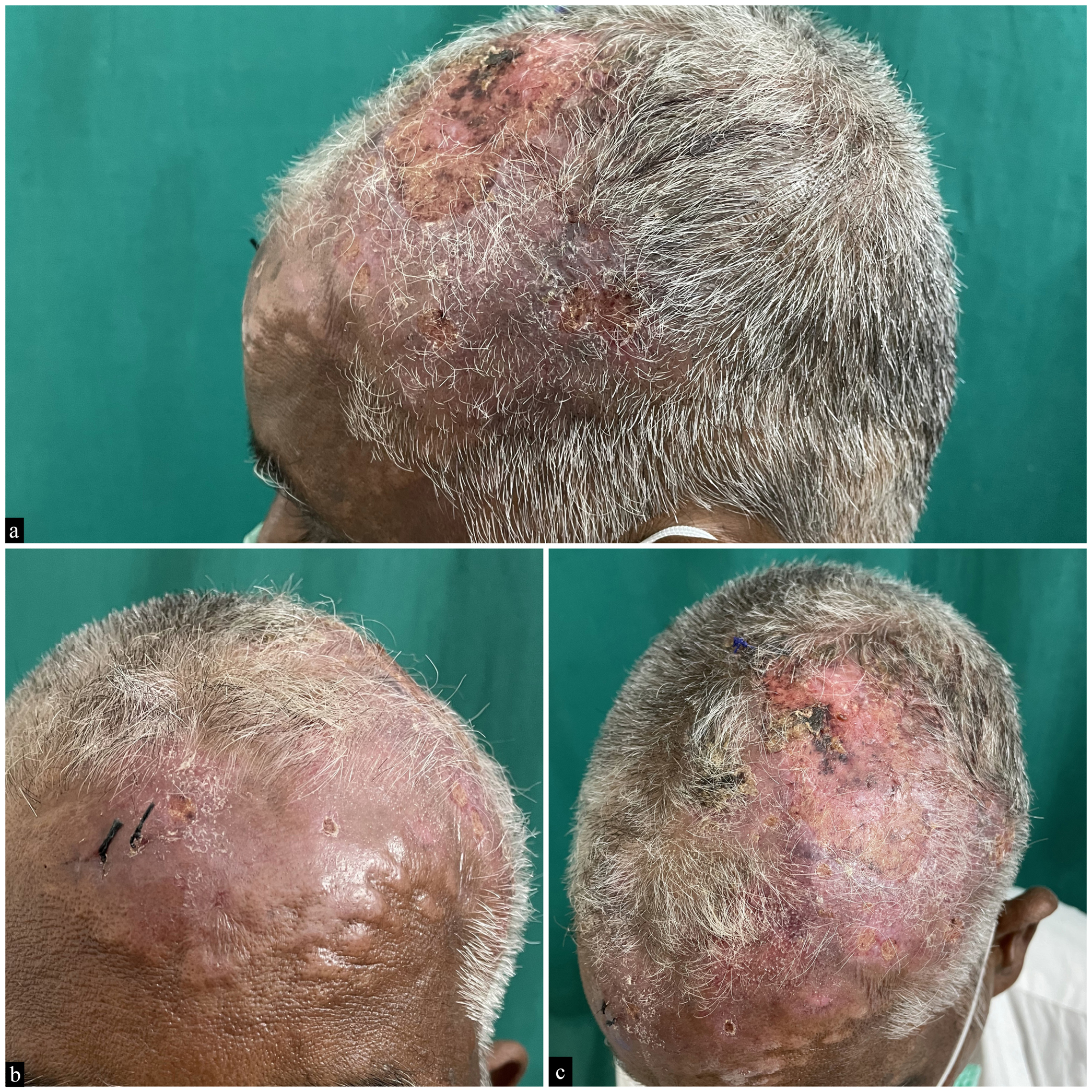 Erythematous, indurated plaque of size 10 × 8 cm with central ulceration over the frontoparietal scalp, multiple smaller skin-colored plaques along the border.