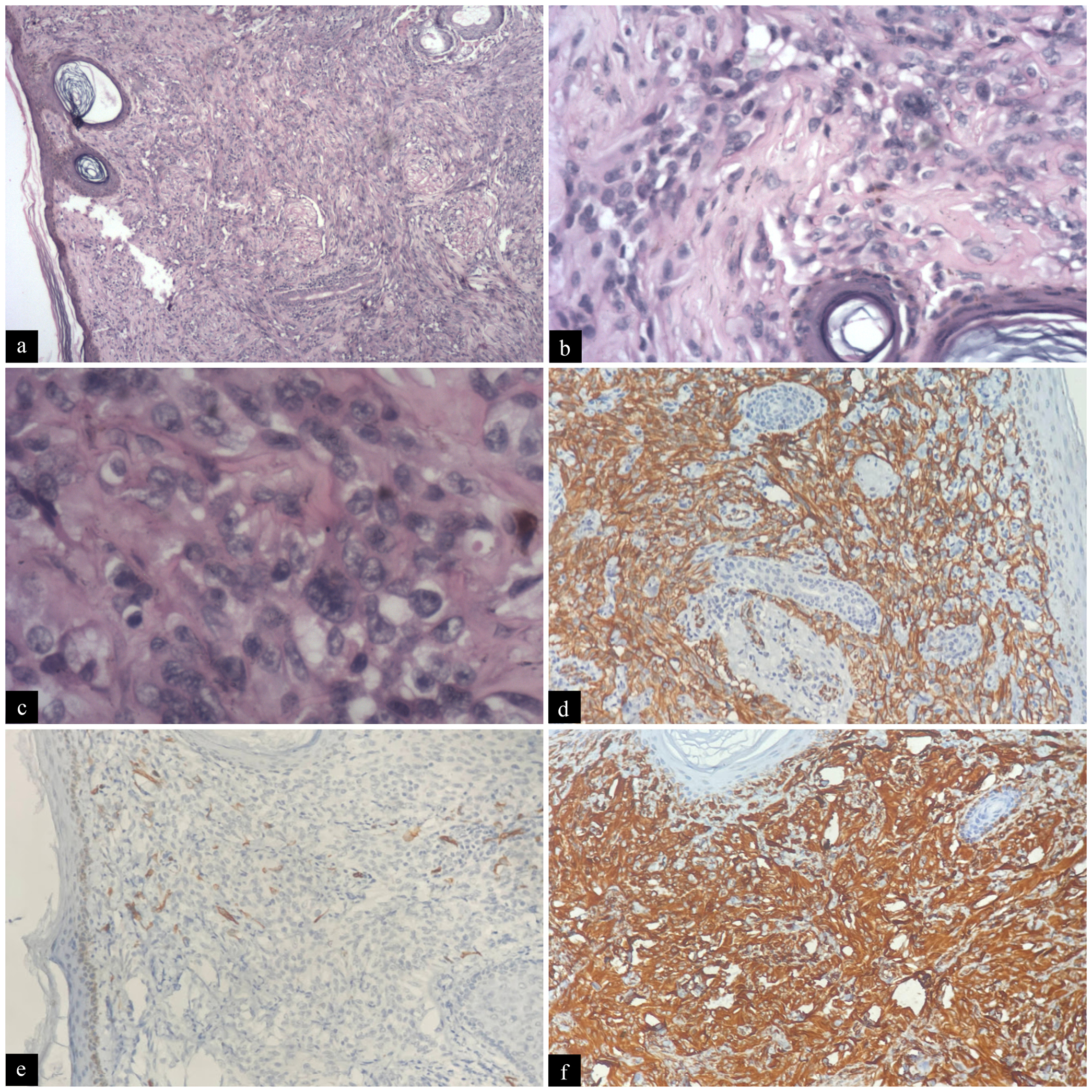 (a) Histopathology revealed numerous irregularly-shaped anastomosing vascular channels with atypical endothelial cells infiltrating the deeper tissues. (H&E, ×4), (b) There were numerous ectatic blood vessels surrounded by tumor cells. (H&E, ×20), (c) The atypical endothelial cells had an epithelioid morphology with vesicular nuclei and prominent nucleoli, and increased mitotic activity. (H&E, ×40), few lymphocytic infiltrates were seen interspersed between these tumor cells. However, no necrosis/hyaline globules were identified, (d) Immunohistochemistry revealed positive for CD31, (e) CD34, and (f) vimentin.