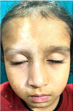 Solitary well-defined off-white macule with irregular border and multiple similar small macules at the margin (‘splashed paint appearance’), extending from the right forehead to the right malar area and nose with sharp demarcation in midline.