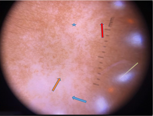 Dermoscopy of the lesion shows irregular whitish areas (star), reticular pigment network (blue arrow), pseudopods at the periphery (red arrow), and perifollicular pigmentation (orange arrow) (3Gen DermLite IV Polarized Dermoscope).