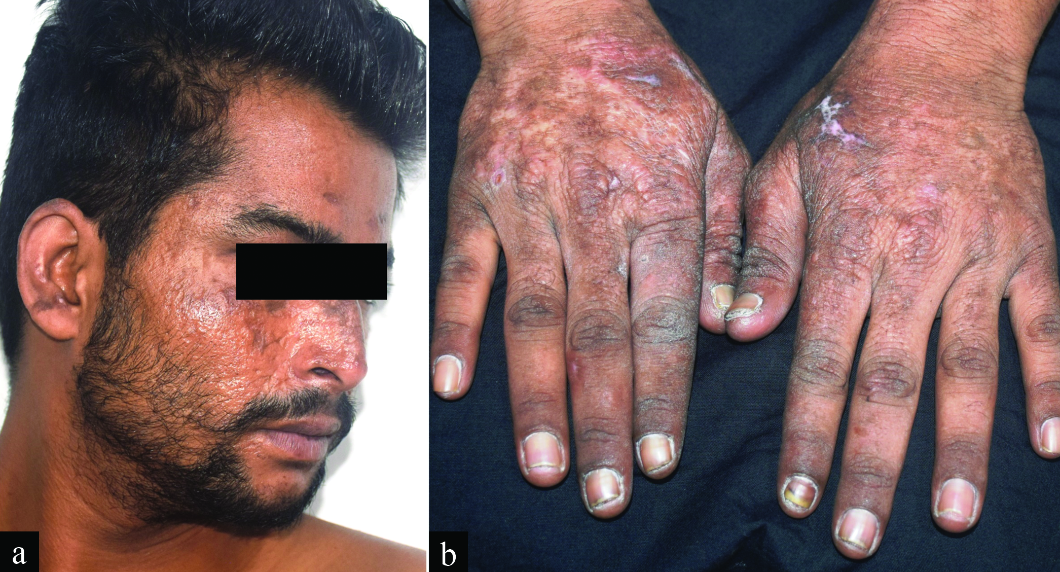 Atrophic scarring and dyspigmentation over the face and dorsum of hands. Note the presence of crusted ulcers over the ear and dorsum of left hand.