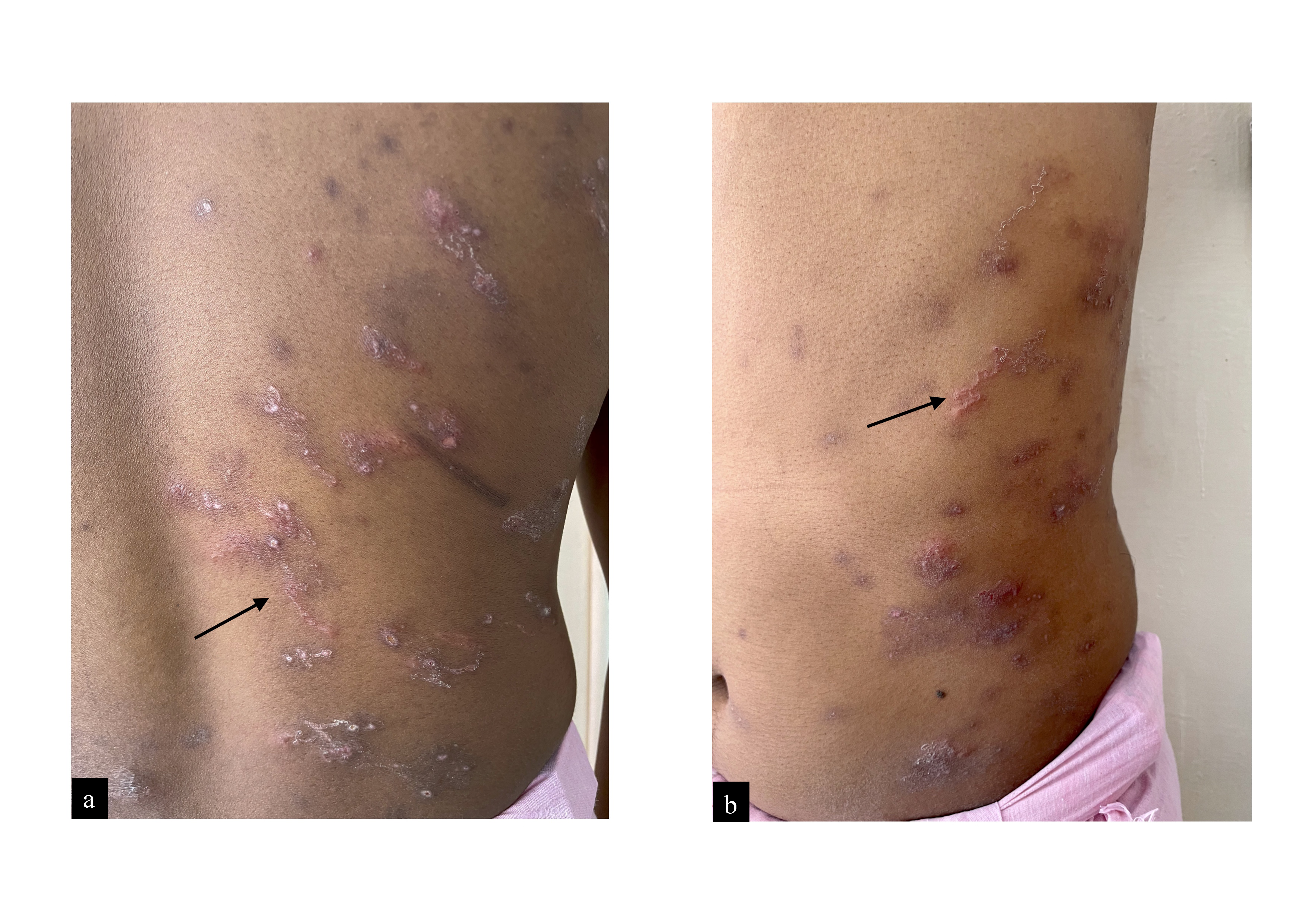 (a) Multiple erythematous papules and serpiginous plaques (black arrows) over the lower back (b) and lateral side of the trunk.