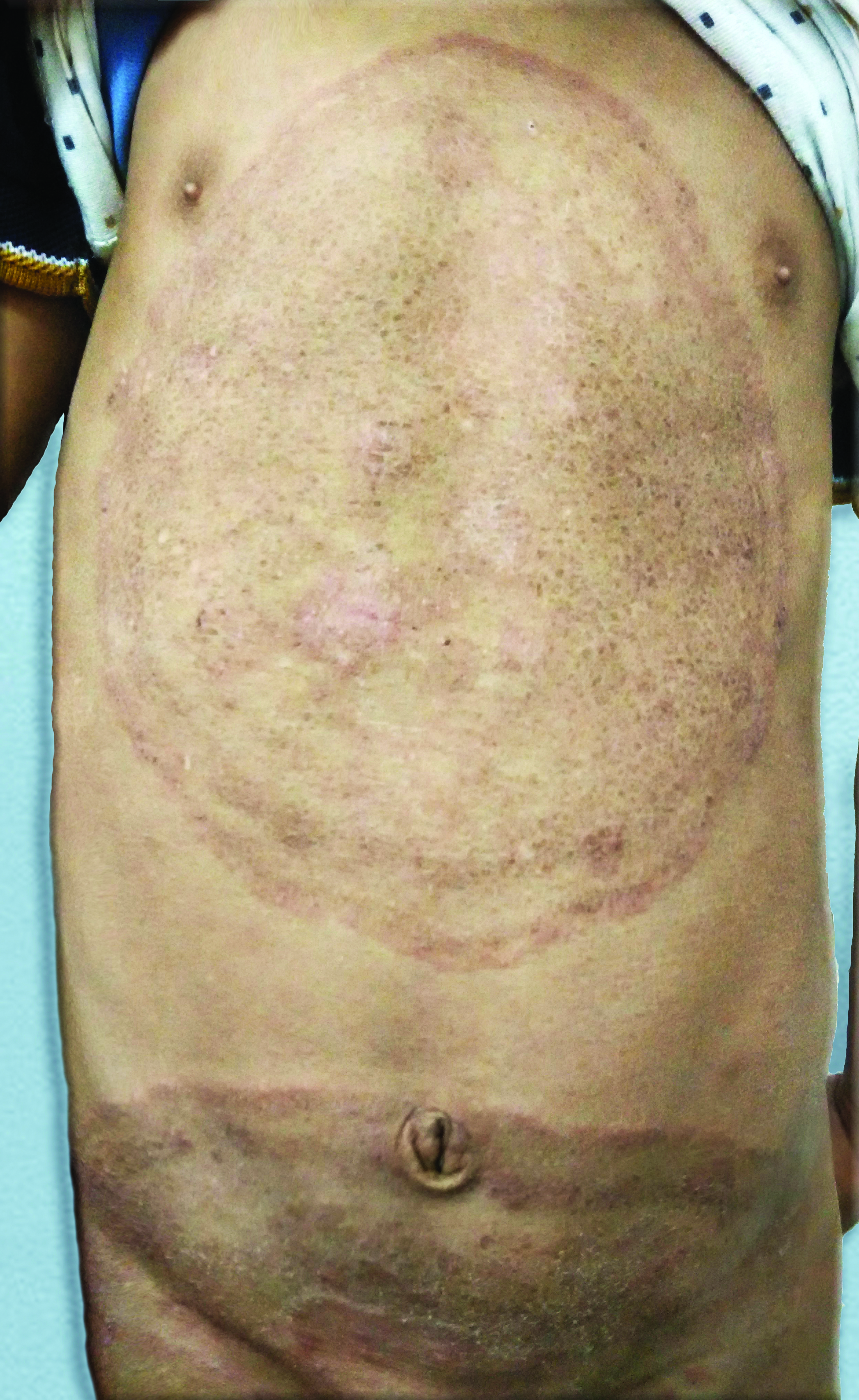 Giant concentric rings of tinea pseudoimbricata over the torso.