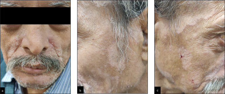 Marsha McCamey on X: Tinea Capitis presents as scaly patches that look  similar to flaking caused by seborrheic dermatitis. To know more Visit:   . . #psoriasis #eczema #acne #jerawat #skincare  #hair #