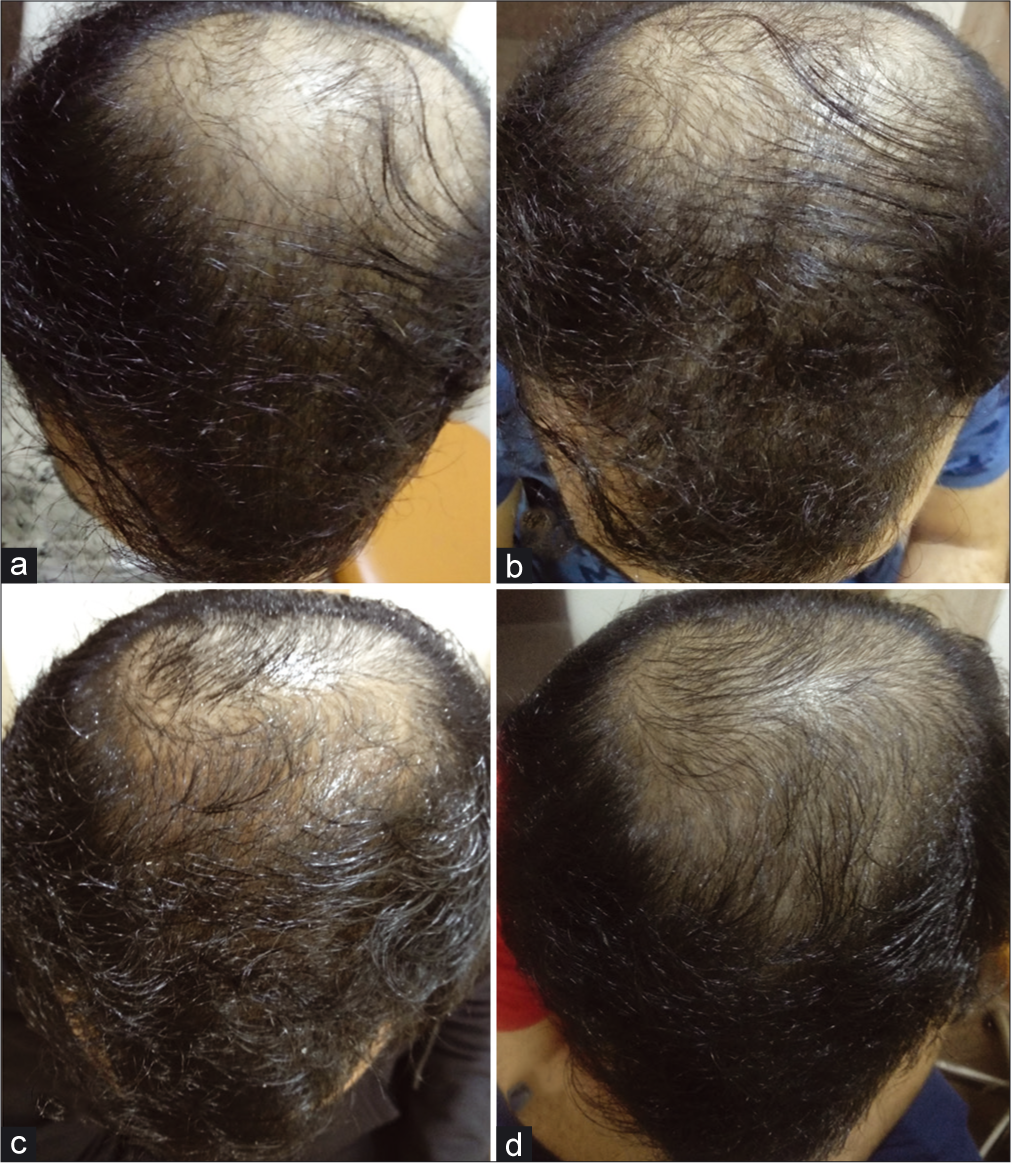 Progression of hair growth after treatment with 2.5 mg/day oral minoxidil (a). Baseline before starting the treatment (b). One month after starting the treatment, slight increase in hair density seen (c). After 2 months, appreciable increase in hair density (d). After 3 months, new hair growth visible with progressive increase in hair density.