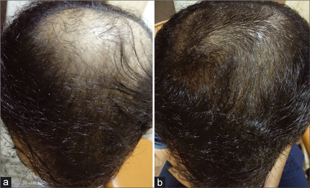 (a and b) Appreciable increase in hair density, with new hair growth over whole scalp at the end of 4 months of treatment as compared to baseline.