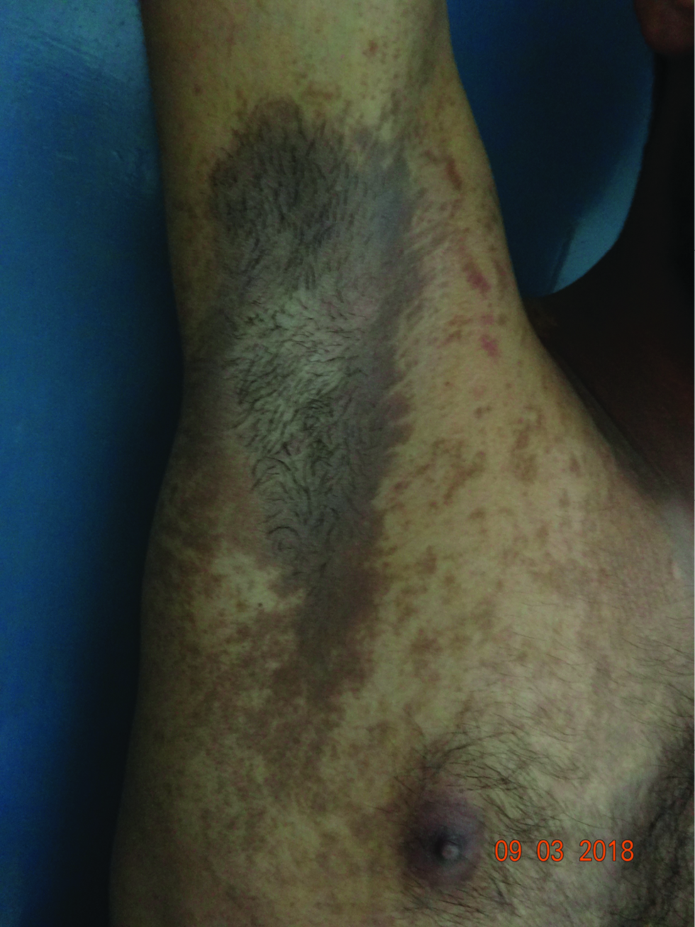 A case of pigmented contact dermatitis to textile dyes showing prominent involvement of axilla with central sparing.