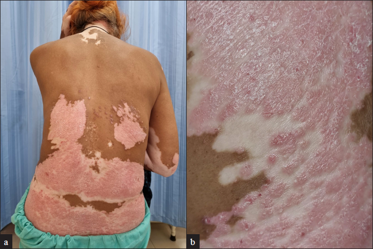 (a) Multiple scaly erythematous indurated plaques of varying sizes colocalised with patches of vitiligo over lower back, elbow and nape of the neck and also present separately over mid to lower back; (b) Multiple scaly erythematous indurated plaques of colocalised with patches of vitiligo over lower back (close up view)