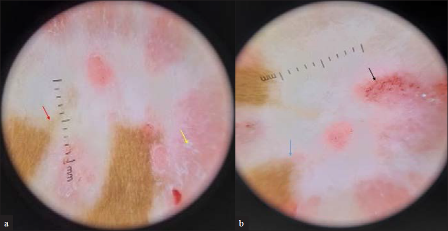 (a) Dermoscopy shows white structureless areas with loss of pigment network and trichrome border (shown by red arrow) suggestive of vitiligo and white scales (shown by yellow arrow) suggestive of psoriasis (Dermlite DL4 4th generation ×10, polarised, contact mode); (b) Dermoscopy shows amoeboid pattern of border (shown by blue arrow) suggestive of vitiligo. and red dotted and glomerular vessels against a pink background (shown by black arrow) suggestive of psoriasis (Dermlite DL4 4th generation ×10, polarised, contact mode)