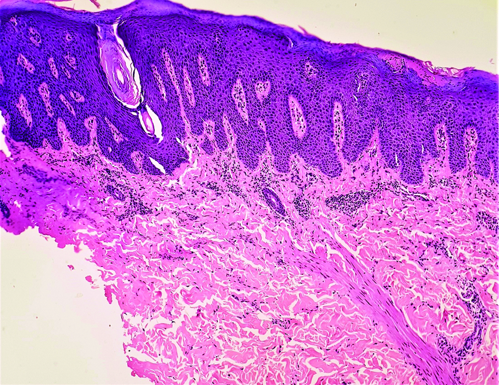 Histopathology shows orthokeratosis, confluent parakeratosis with neutrophilic collections in stratum corneum and spinosum, psoriasiform hyperplasia, dilated blood vessels, suprapapillary thinning, and perivascular lymphohistiocytic infiltrate in upper dermis (H&E ×100)